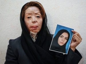 iran, a woman suvival of acid attack